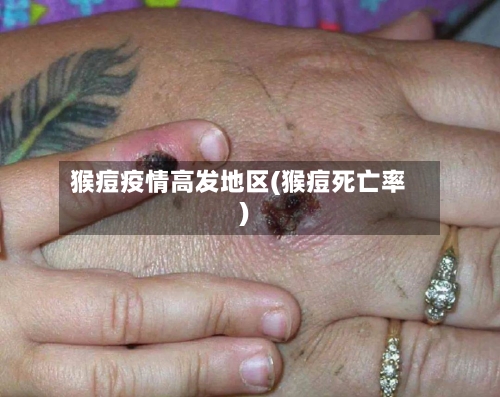 猴痘疫情高发地区(猴痘死亡率)