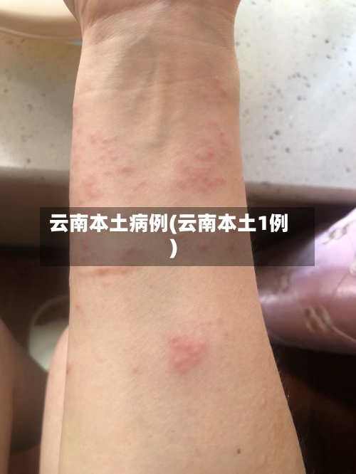 云南本土病例(云南本土1例)